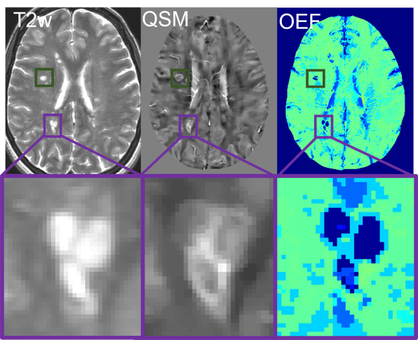 Clinical application showing T2w, QSM, and OEF brain imaging with detailed regional analysis